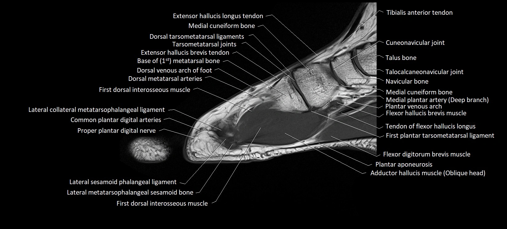MRI foot sagittal labelled cross sectional anatomy image  9.webp
